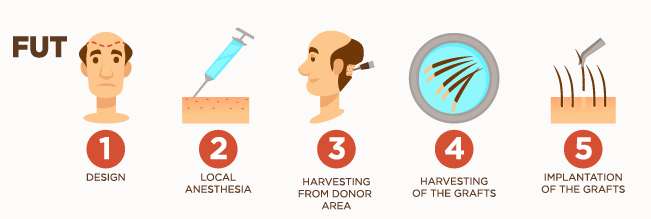 FUT Hair Transplant - Benefits | Disadvantages | Cost | Duration |  Precautions - Luxor Hospital